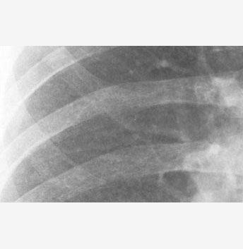 asbestosis 1/1 p/p