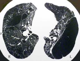 Chest CT scan -- hyperinflation