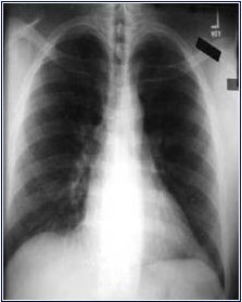 Chest X-ray -- hyperinflation