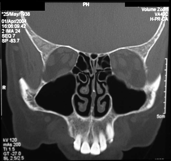 Sinusitis Ct